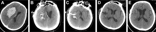 Figure 3 Pre- and post-operation CT scans of a basal ganglia hemorrhage that was evacuated by neuroendoscopy.