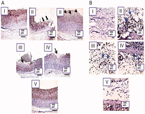 Figure 9. Photomicrographs of rat's stomachs immunostained against COX-2 in (A) the glandular gastric mucosa and (B) the submucosal inflammatory cells. I, II, III, IV, and V are as under Figure 6. X: 100 bar 100 (the glandular gastric mucosa) and X: 400 bar 50 (the submucosal inflammatory cells). Rim of ulcer (thick black arrows), area of mucosal necrosis (thin black arrows), positively stained submucosal infiltrating inflammatory cells (blue arrows).