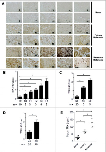 Figure 1. TRX is highly expressed in human melanoma and positive related to tumor progression. (A) Immunohistochemistry (IHC) staining of thioredoxin (TRX) in human melanoma samples and control nevus. 1–10: nevus, 11–20: primary melanoma, 21–30: metastasis melanoma. Scale bar, 100 μm. (B-D) Histogram graph showing the quantitative evaluation of TRX staining intensity from Figure 1A. Statistical analysis was performed by Student's t-test; *P < 0.05. T-Primary tumor, T0-No evidence of primary tumor, Tis-Carcinoma in situ; intraepithelial or invasion of lamina propria, T1-Tumor invades submucosa, T2-Tumor invades muscularis propria, T3-Tumor invades through muscularis propria into subserosa or into non-peritonealized pericolic or perirectal tissues, T4-Tumor directly invades other organs or structures and/or perforates visceral peritoneum. N-Regional lymph nodes, N0-No regional lymph node metastasis, N1-Metastasis in 1 to 3 regional lymph nodes, N2-Metastasis in 4 or more regional lymph nodes. M-Distant metastasis, M0-No distant metastasis, M1-Distant metastasis. (E) Relative serum TRX protein levels from nevus, primary melanoma and metastatic melanoma patient groups as determined by ELISA. Statistical analysis was performed by Student's t-test; *P < 0.05.