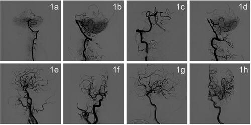 Figure 1. (a–h). Angiography showing acute basilar artery occlusion.(a, b) The left vertebral arteriogram in the frontal and lateral view shows occlusion of the basilar artery, with a small amount of PICA flow compensating for the occluded segment of the basilar artery and intermittent visualization of the lumen of the basilar artery. (c, d) A frontal and lateral view of the right vertebral artery angiogram shows occlusion of the basilar artery with a small amount of antegrade compensation of the PICA branch. (e, f) A right internal carotid artery system frontal and lateral angiogram shows no significant abnormalities, and an embryonic posterior cerebral artery was observed. (g, h) A front and side view of the left internal carotid artery system showed no significant abnormalities, and the embryonic posterior cerebral artery was observed (Figure 2).
