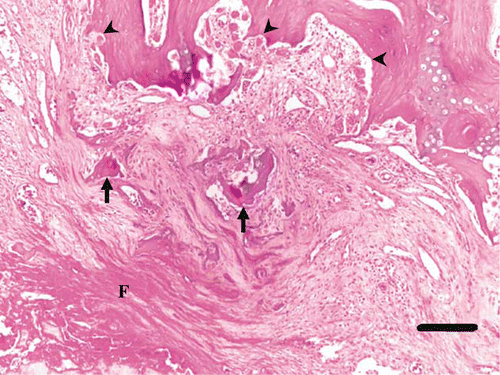 Figure 6.  Histology of the articular surface of the left femoral head of a juvenile YEP with bilateral coxofemoral degenerative joint disease (haematoxylin and eosin). The cortical bone and articular cartilage are absent, and remaining superficial trabecular bone has been covered by maturing sheets of collagen interspersed with fragments of bone (arrows), with layers of superficial fibrin (F). Within intact trabecular bone there is active resorption by many osteoclasts, and Howship's lacunae are prominent (arrowheads). Scale bar = 150 µm.