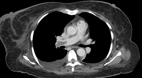 Figure 1 A CT pulmonary angiography (CTPA) revealed a filling defect in the pulmonary arterial phase in the right main pulmonary artery cava. and right pleural effusion.