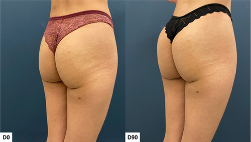 Figure 8 Case 4, Buttocks Beautification 3D. Standardized oblique images pre and 90 days post injection.