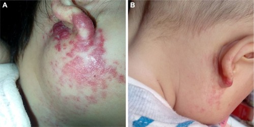 Figure 5 (A) An 11-month-old female patient with a hemangioma located on the right parotid region. (B) The hemangioma on the same patient involuted after 4-month treatment of oral propranolol.