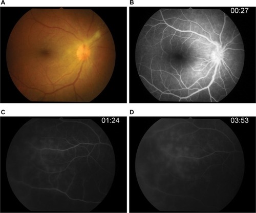 Figure 3 Fluorescein angiography.