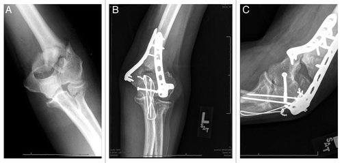 Figure 2: (B) PA and (C) lateral radiographs of a distal humeral atrophic nonunion, thirteen-months following open reduction and internal fixation of a comminuted, open distal humerus fracture. (A) Extensive soft tissue damage and periosteal stripping at the time of injury likely contributed to inadequate vasculature and for healing.