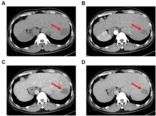 Figure 7 Computed tomography (CT) scans before stage II surgery. Reduce of tumor load (red arrow) was showed on CT scans. (A) plain scan; (B) arterial phase; (C) portal venous phase; (D) venous phase.