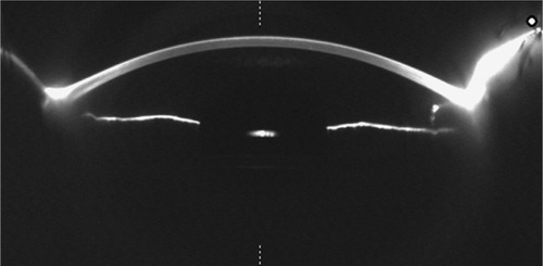 Figure 7 Anterior segment photography of the left eye using a Scheimpflug-based camera.