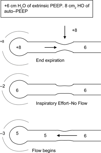 Figure 2B Applying external PEEP helps reduce WOB. Effect of adding external PEEP. Extrinsically applied PEEP reduces the amount of negative pressure needed to generate airflow.