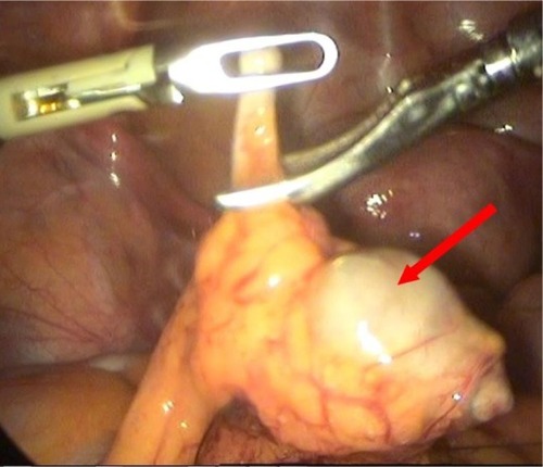 Figure 4 IUD embedded in the omentum.