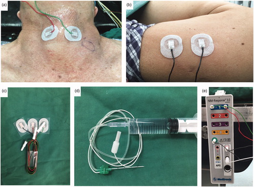 Figure 2. Establishment of neural monitoring system (a) A pair of cutaneous, surface-electrodes were attached to the neck skin of the left and right lamina of the thyroid cartilage (b) Another pair cutaneous surface electrodes were attached to the upper arm of the patient (c) Ambu® Neuroline 715 single patient surface electrodes (d) Nerve stimulation needle was connected to a saline syringe as a stimulating electrode (e) All electrodes were connected an interface-connector box.