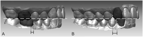 Figure 2. Measurements of the bilateral first molar (A) and canine (B) in the sagittal view were performed by defining the most mesial points of the upper and lower first molars (A) and the most distal points of the upper and lower canines (B).