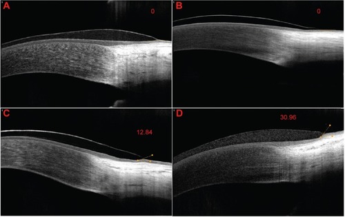 Figure 3 Angle of conjunctival indentation was measured by optical coherence tomography for different edge designs.