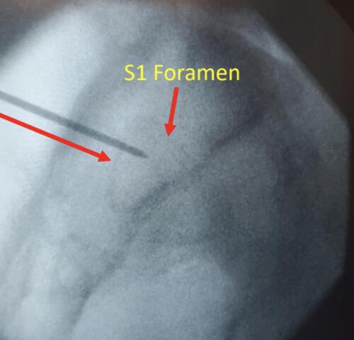 Figure 2 Optimal placement of guide pin in lateral view.