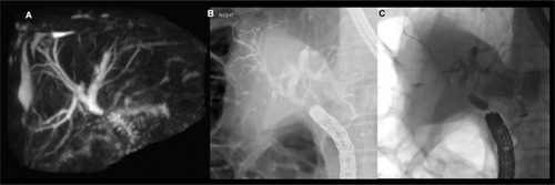 Figure 4 (A) Magnetic resonance cholangiopancreatography of anastomotic stricture at hepaticojejunostomy. (B) Colonoscopy was used to intubate the afferent limb and locate the anastomotic stricture. (C) Dilatation of anastomotic stricture using 6 mm balloon over the wire.