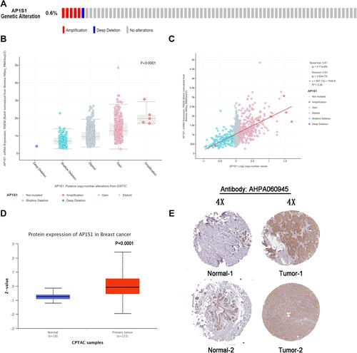 Figure 2 The genetic alteration and protein expression of AP1S1. (A) The genetic alteration frequency of AP1S1 in breast cancer using the cBioPortal tool. (B) The correlations between the mRNA expression level and genetic alterations of AP1S1 from cBioPortal. (C) The correlations between the mRNA expression level and copy number of AP1S1 from cBioPortal. (D) The protein expression of AP1S1 in breast cancer from CPTAC database. (E) IHC slices of AP1S1 in breast from HPA.