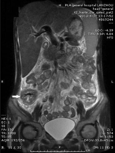 Figure 3 Abdominal magnetic resonance imaging (coronal plane).