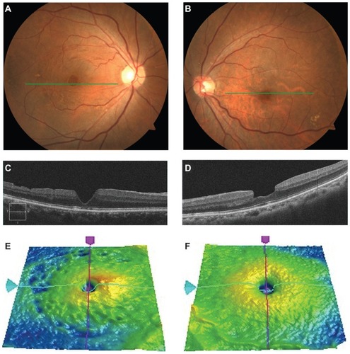 Figure 2 Color fundus photographs and Cirrus OCT images of an 80-year-old woman who underwent vitrectomy with and without ILM peeling for bilateral macular holes.