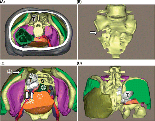 Figure 4. 3D reconstruction of the tumor region for patient 1. (A) Superior view of the entire 3D model of the tumor region: “T” indicates the chordoma (in white). (B) The sacrum: the arrow shows the bony destruction. (C) Superior view with some structures cut away to show the spatial relationships between the tumor and peritumoral structures: (1) bladder; (2) rectum; (3) gluteus maximus; (4) gluteus medius; (5) piriformis; (6) right internal iliac vessels. “S” indicates the sacrum, “I” the ilium. (D) Posterior view. In this 3D tumor region the tumor features and relationships to peritumoral structures are clearly depicted.