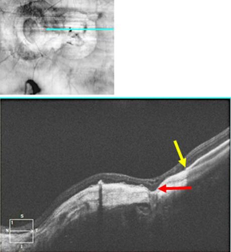 Figure 2 Red free photograph (top) and spectral domain OCT image (bottom) from the left eye of a 68-year-old man with pathologic myopia and a previously undescribed variant of macular intrachoroidal cavitation. The lesion occurs in an area of RPE and choroidal atrophy in an area of excavation of the thickened subjacent sclera producing a pseudofovea of a sort different from that described in macular intrachoroidal cavitation.