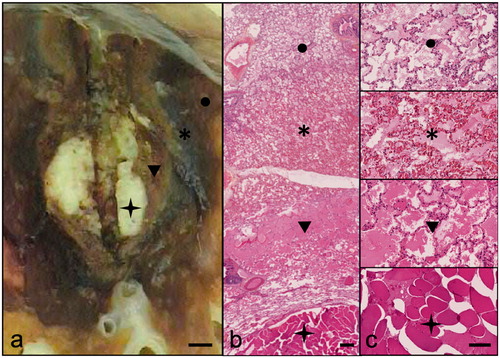 Figure 3. Pathological assessment of ablation zones. This figure is a representative example of pathological findings after MWA of tumor mimic lesions. Macroscopic analysis (a: scale bar 2mm) shows concentric layers centered by the TML (star), a clear area (arrowhead) and a dark zone (asterisk) surrounded by edema (circle). Hematoxylin Eosin staining at ×10 (b: scale bar 200μm) and ×100 (c: scale bar 50μm) present coagulation necrosis in the clear zone (arrowhead) and hemorrhagic alterations in the dark zone (asterisk). The surrounding lung tissue shows reactional alveolar edema (circle). The limits of the ablation zone are typically at the internal interface of the dark zone (hemorrhagic rim).