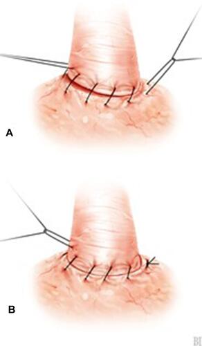 Figure 4 VUA technique with RS. (A) Approximation of urethra and bladder neck. (B) Knotting (Image courtesy of ©Stephan Spitzer, medizillu.de; https://www.spitzer-illustration.com/index.php).