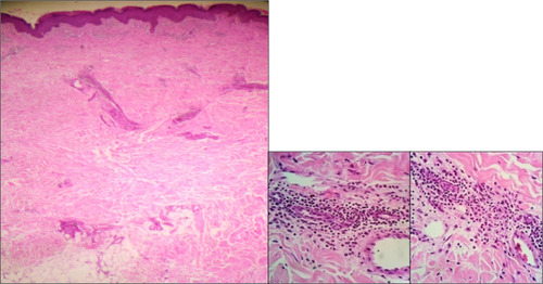 Figure 6 The epidermis with superficial and deeper extension full of inflammatory infiltrates, numerous lymphocytes and a few eosinophils.