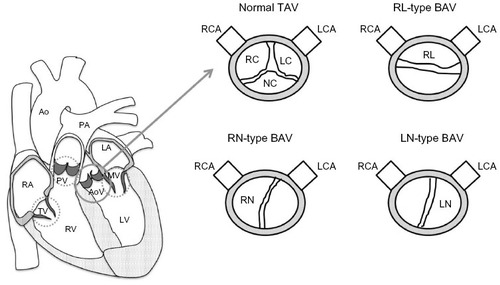 Figure 1 Representation of a normal TAV and different types of BAV.
