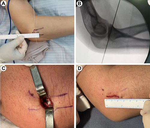 Figure 2 Surgical technique applied to a 27-year-old male patient with Mason type II fracture. (A) Mark of the incision location preoperation; (B) Preoperative fluoroscopy to locate the incision; (C) Exposure of the fracture region and insertion of the screws; (D) Photo of incision postoperation.