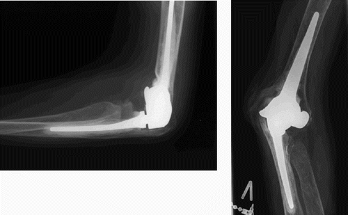 Figure 2 a. Postoperative lateral view. The arrows mark adequate cement mantle around the ulnar stem extending past the tip, and the inadequate cement mantle of the humeral stem, which does not extend past the tip of the component. b. Postoperative anteroposterior view. Note the preservation of the distal humeral condyles with muscular and ligamentous attachments, thereby improving soft tissue stability of the arthroplasty and reduction of peak forces at the interfaces. The radial head has routinely been removed. Pre- and postoperative radiographs of the GSB III elbow arthroplasty in a 58-year-old woman with severe rheumatoid destruction of the elbow joint.