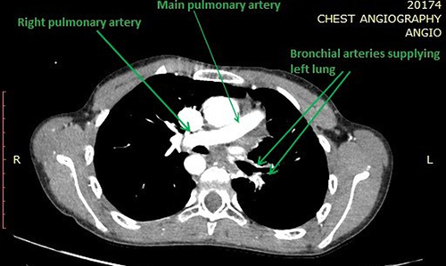 Figure 3 Chest CT scan showing continuation of main pulmonary artery as right pulmonary artery and absence of left pulmonary artery and left lung supplied by collaterals.