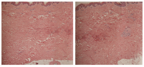 Figure 2 Skin biopsy reveals the diagnosis