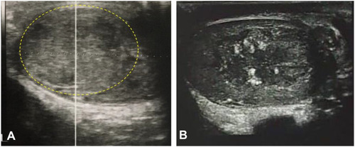 Figure 2 Ultrasound of the testicles of Case 1 (A) and Case 2 (B).