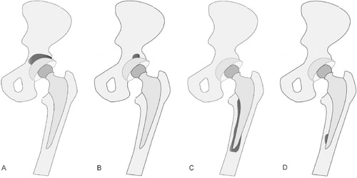 Figure 1. Definitions used for the 18F-fluoride PET uptake patterns on the acetabular and femoral sides. A. Major-uptake region on the acetabular side: 18F-fluoride uptake has spread to more than 50% of the acetabular component with an SUVmax of > 5. B. Minor-uptake region on the acetabular side: 18F-fluoride uptake has localized in less than 50% of the acetabular component with an SUVmax of > 5. C. Major-uptake region on the femoral side: 18F-fluoride uptake has spread to more than 50% of the femoral component with an SUVmax of > 5. D. Minor-uptake region on the femoral side: 18F-fluoride uptake has localized in less than 50% of the femoral component with an SUVmax of > 5.