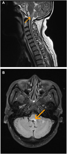 Figure 1 MRI of patient 20 showing abnormal signals in the medulla oblongata as indicated by arrows. (A) T2-weighted cerebral MRI. (B) FLAIR sequences.