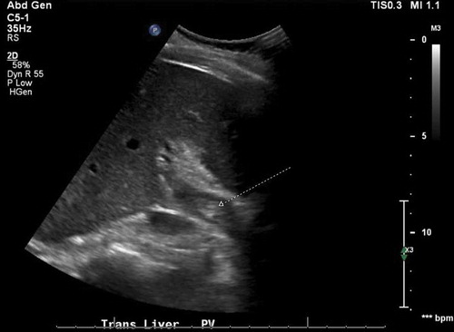 Figure 2. Abdominal ultrasonography revealing moderate non-occlusive thrombus within the main portal vein.