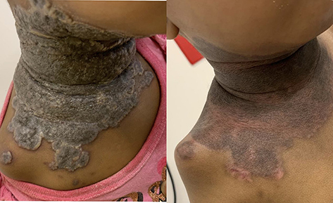 Figure 3 Before and after images of vegetative plagues with surface erosions as well as characteristic snail-track border.