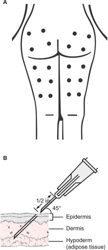 Figure 1 (A) Points of CO2 infusion; (B) position and angulation of needle placement for infusion, depth of ~10 mm (30 G × 1/2 inch size needle).