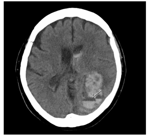 Figure 3 CT scan showing large left parietal lobe lobar hemorrhage with a fluid level (arrow) after the patient received r-TPA.