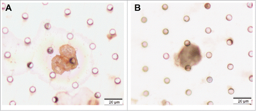 Figure 3. CK5/6 and P63 staining by IHC. A, staining of CK5/6; B, staining of P63.