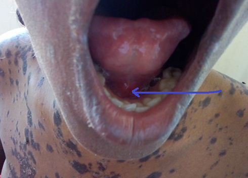Figure 2 This figure, with arrow, shows buccal mucosa involvement on the 5th day.