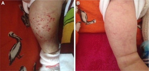 Figure 4 (A) An 8-month-old female patient with a hemangioma located on her right leg. (B) The hemangioma on the same patient involuted after 4-months treatment of oral propranolol.