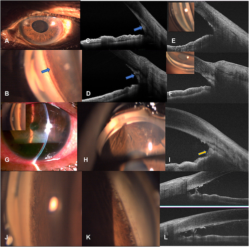 Figure 2 (A–D) show a pseudophakic patient with pseudoexfoliation glaucoma that developed early IOP spike. (A) Diffuse slit-lamp photograph, (B) Gonioscopy demonstrating thin transparent membrane over the region of the open trabecular shelf. (C and D) shows the ASOCT image demonstrating a hyperreflective membrane over the opened trabecular region (Arrows). (E and F) show similar ASOCT images showing hyperreflectivity of the region with inset showing with poor view of the opened trabecular shelf. (G–I) show the slit-lamp picture showing macrohyphema within 1 week after surgery (G), inset showing open trabecular shelf at 1 week with blood clots in angle. (H) shows the presence of broad PAS on gonioscopy in the inferior quadrant that was confirmed on ASOCT ((I) Arrows). (J–L) show the gonioscopy images of a patient with developmental glaucoma with abnormal iris (J and K), showing iris strands and open trabecular shelf at 1 month after surgery on ASOCT (L).