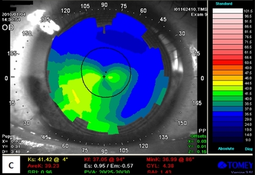 Figure 3-C Patient 2: TMS with improved inferotemporal steeping after one week of Intacs SK implantation.