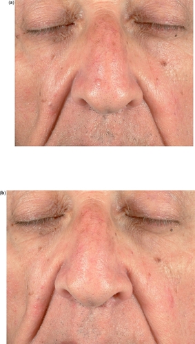 Figure 2 Nodular BCC of the nose before (a) and after (b) 6 weeks of treatment with IQ 5% cream 5 applications/week: complete clearance.