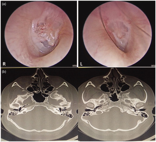 Figure 1. (a) Endoscopic view showing underdevelopment of the tympanic membrane with an abnormal-looking malleus. (b) Computed tomography of the temporal bone showing bilateral stenotic bony part of the external auditory canal.