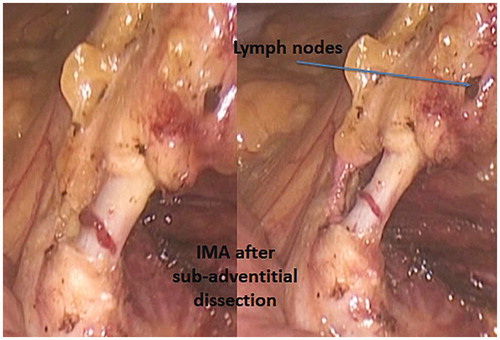 Figure 10. The sub-adventitial route to IMA dissection entails two advantages: the lengthening of the vessel which gives more room for clipping and distances the hypogastric nerves, and the guarantee of a complete lymph node clearance.