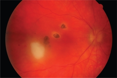 Figure 1 Recurrent toxoplasma retinochoroiditis. A ‘satellite lesion’ associated with pre-existing retinochoroidal scars is present at the right macula. The lesion became inactive over a period of several weeks. The acute retinochoroiditis extended temporally from the fovea.