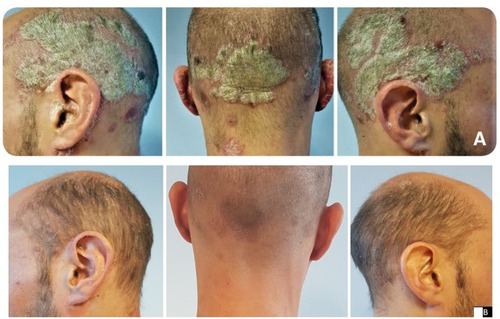 Figure 3 Case 3: (A) before and (B) after treatment for 4 weeks with calcipotriol (50 µg/g)/betamethasone dipropionate (0.5 mg/g) aerosol foam.