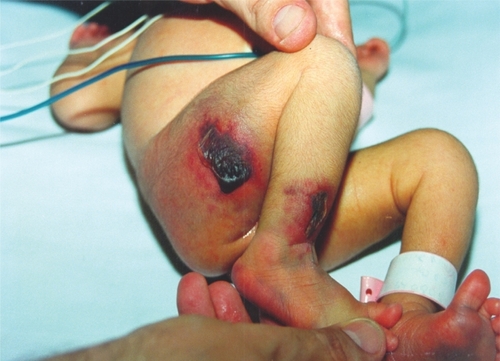 Figure 1a Five-day-old newborn with homozygous protein C deficiency and purpura fulminans. Irregularly formed hypoperfused or necrotic skin lesions surrounded by an inflammatory border.